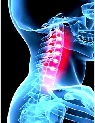 Klinikinis osteochondrozės vaizdas